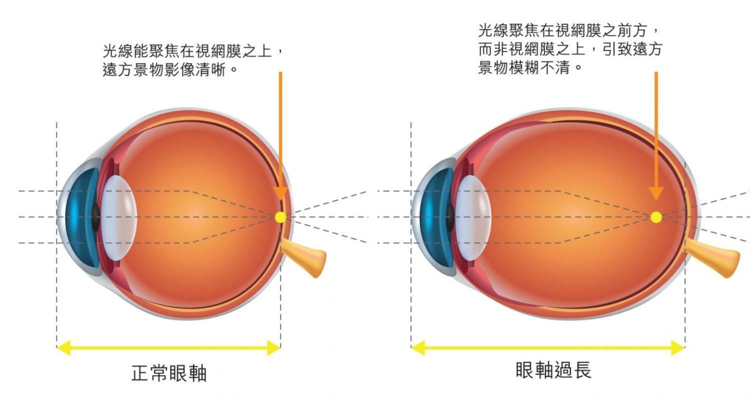 近視與眼軸的關係｜為什麼眼軸變長就會近視？